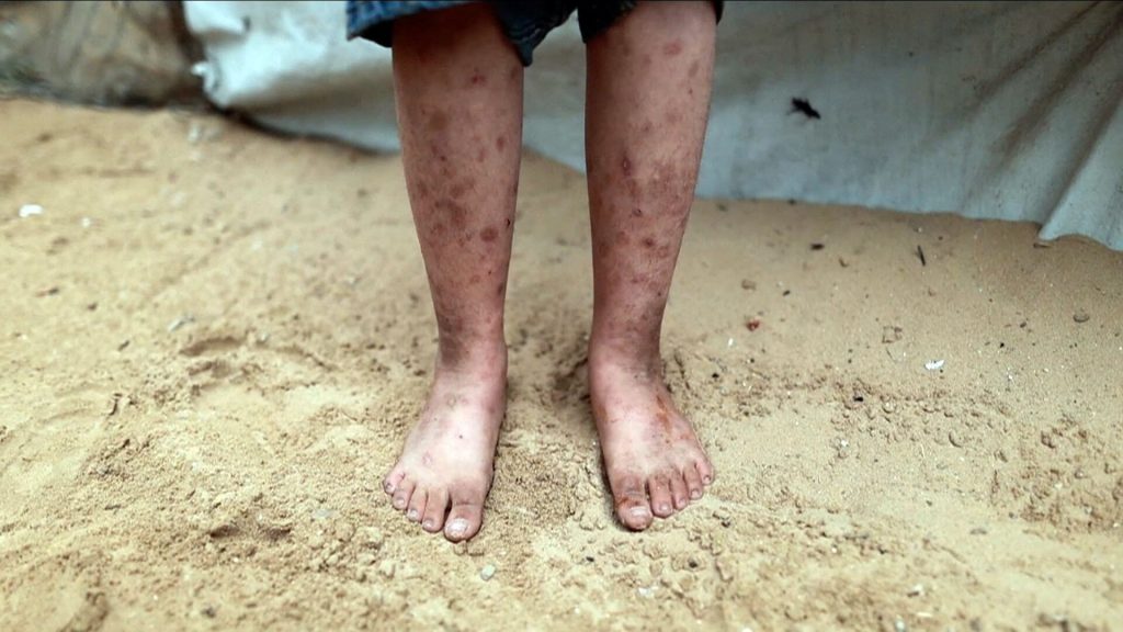 تتفاقم الأوضاع الصحية في قطاع غزة في ظل استمرار النزوح وتدهور الظروف المعيشية
